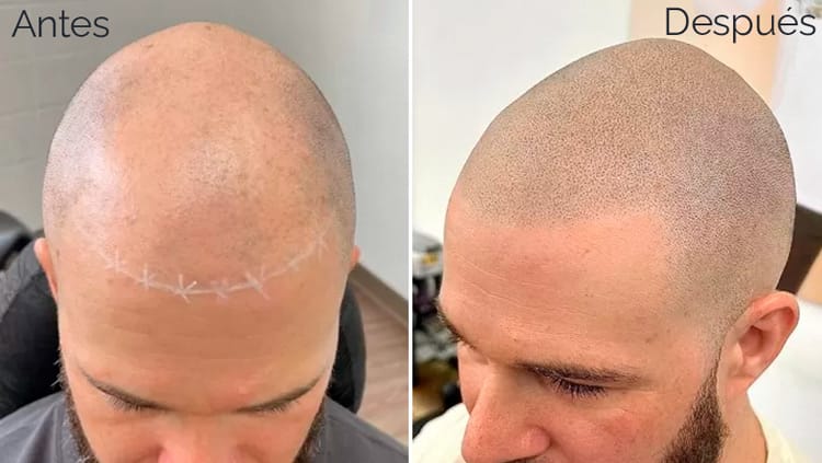 Inicio 10 micropigmentacion-capilar-en-valencia