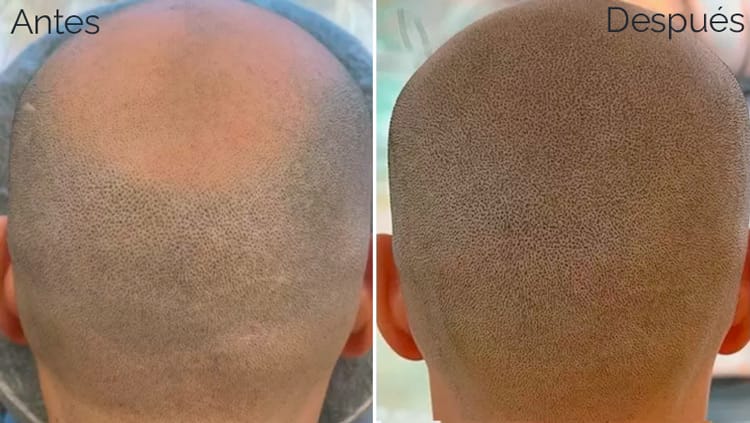 Inicio 11 micropigmentacion-capilar-precio