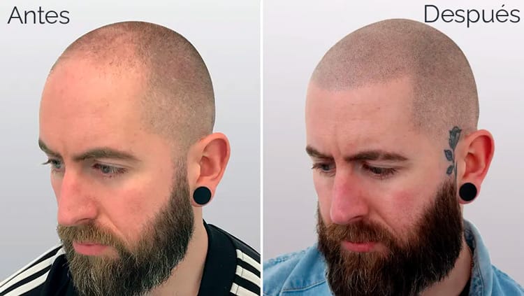 Inicio 12 micropigmentacion-capilar-valencia