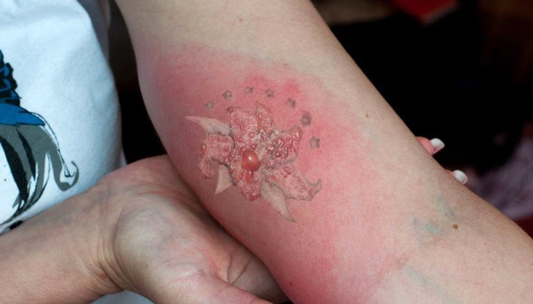 Cómo Se Ve Un Tatuaje Infectado 1 Cómo Se Ve Un Tatuaje Infectado